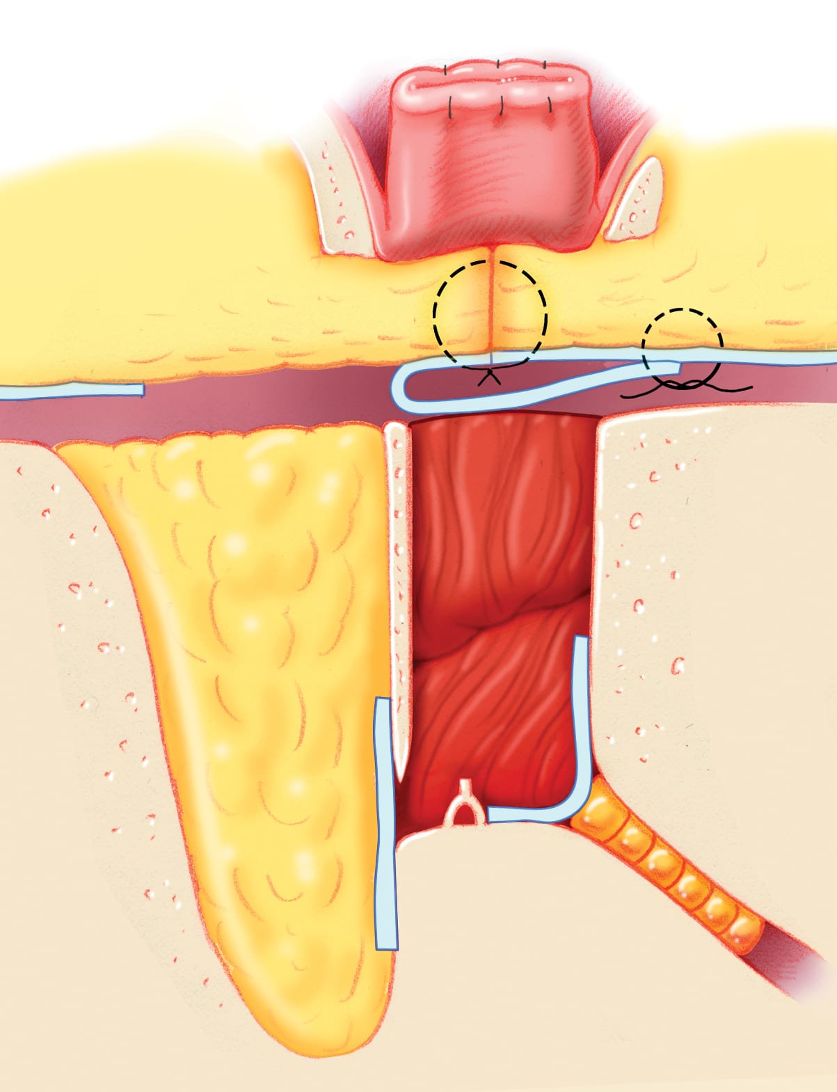 Cerebrospinal Fluid Leak | Jackler Collection | Volumes Cerebrospinal Fluid Leak | Jackler Collection | Volumes
